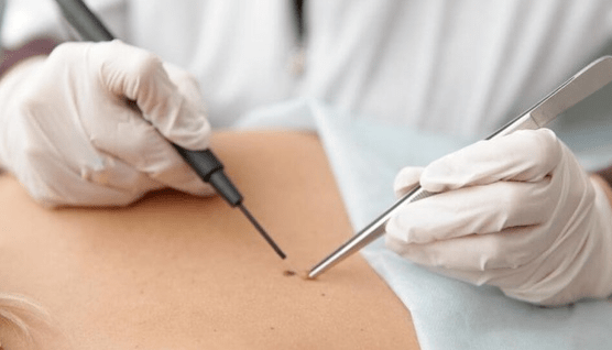 Papilloma removal features