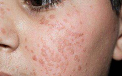 Flat papillomas on the face