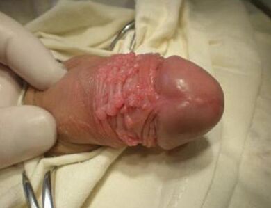 Papilloma over a member