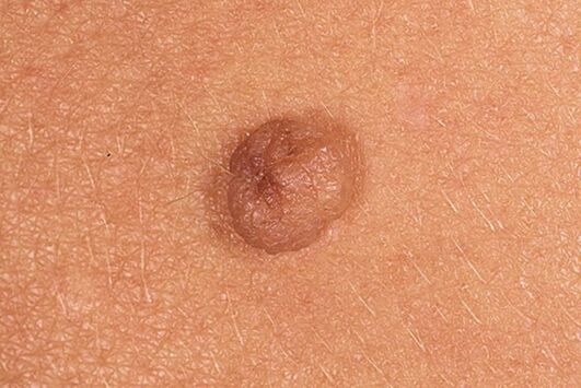 Papilloma simple