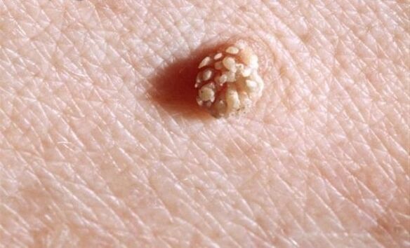Papilloma in the human body