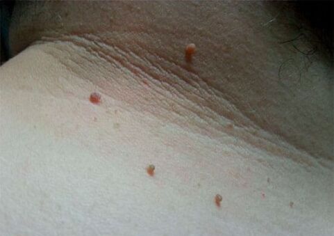 Papilloma in the neck