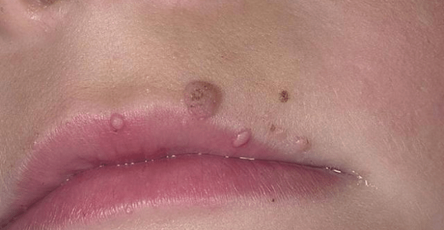 Papilloma on the edge