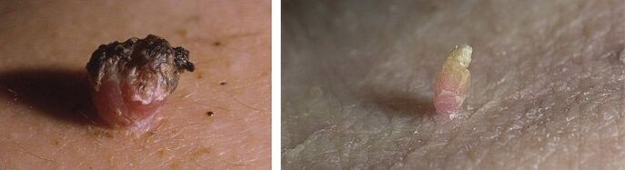 Papilloma on the skin