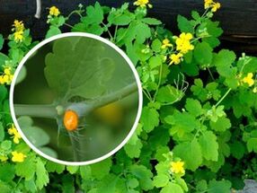 celandine herbal juice for the treatment of plantar warts